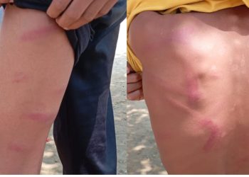 सिरहामा शिक्षकको कुटपिटबाट ८ कक्षाका विद्यार्थी घाइते, अस्पताल भर्ना