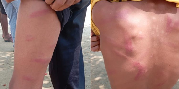 सिरहामा शिक्षकको कुटपिटबाट ८ कक्षाका विद्यार्थी घाइते, अस्पताल भर्ना